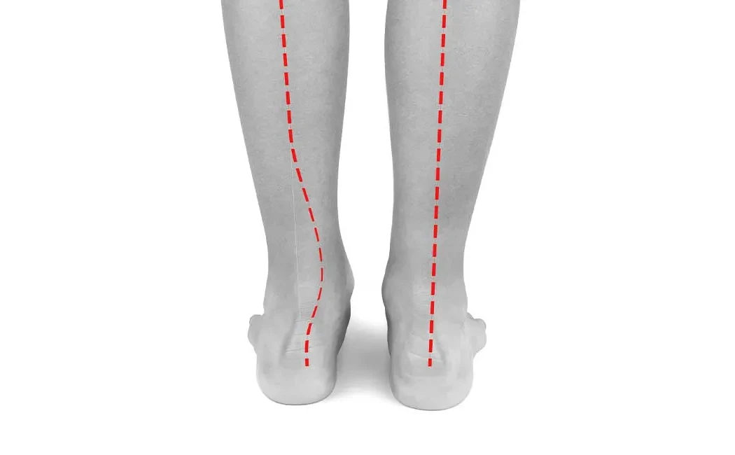 Bacak Eğriliği Ameliyatı: Eklem Sağlığı ve Fonksiyonel Düzeltme