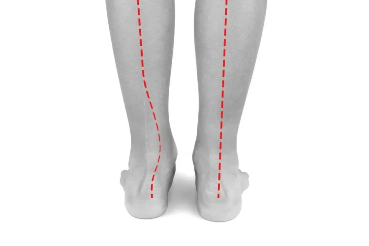 Bacak Eğriliği Ameliyatı: Eklem Sağlığı ve Fonksiyonel Düzeltme