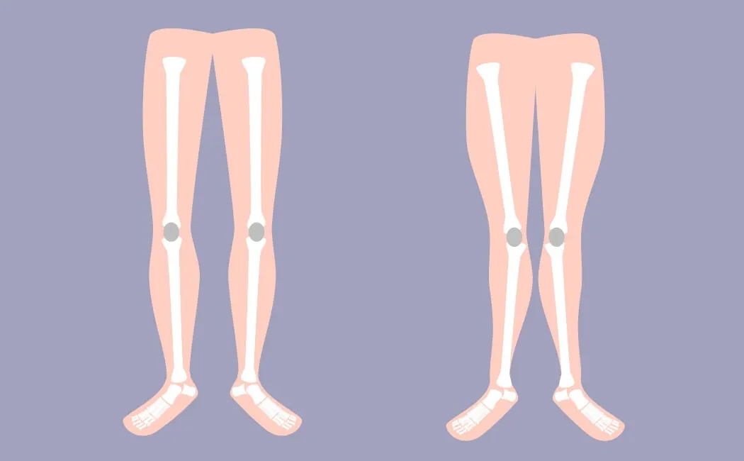 Bacak Eğriliği Düzeltme: X ve O Bacak Cerrahisi Rehberi
