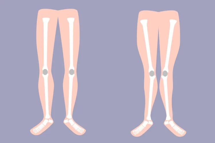 Bacak Eğriliği Düzeltme: X ve O Bacak Cerrahisi Rehberi
