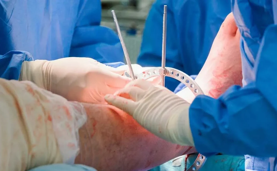 Boy Uzatma Ameliyatı Yöntemleri: İlizarov, Precice ve Diğer Teknikler