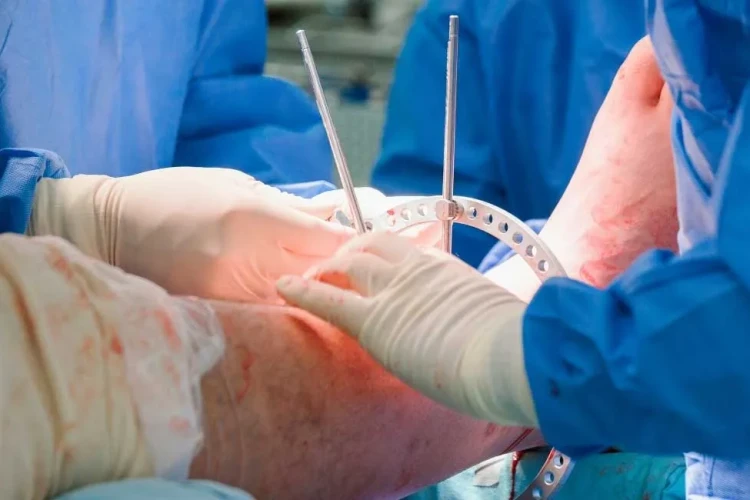 Boy Uzatma Ameliyatı Yöntemleri: İlizarov, Precice ve Diğer Teknikler