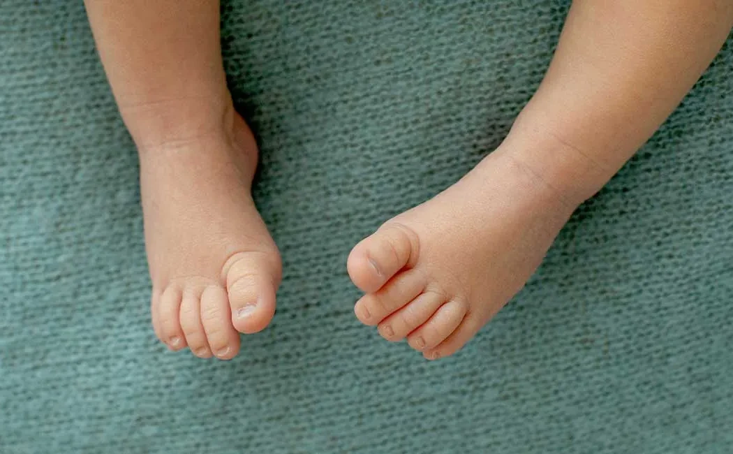 Çocuklarda Ayak Deformiteleri: Pes Ekinovarus (Çarpık Ayak) Tedavisi