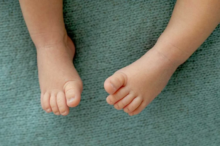 Çocuklarda Ayak Deformiteleri: Pes Ekinovarus (Çarpık Ayak) Tedavisi