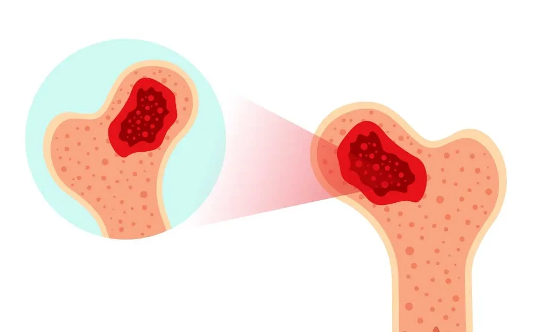 Çocuklarda Kemik Tümörleri: Belirtiler ve Erken Teşhis Önemi