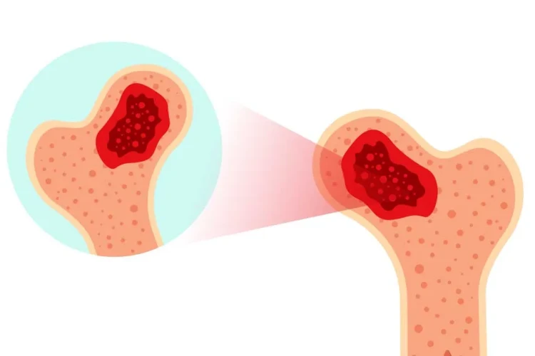 Çocuklarda Kemik Tümörleri: Belirtiler ve Erken Teşhis Önemi