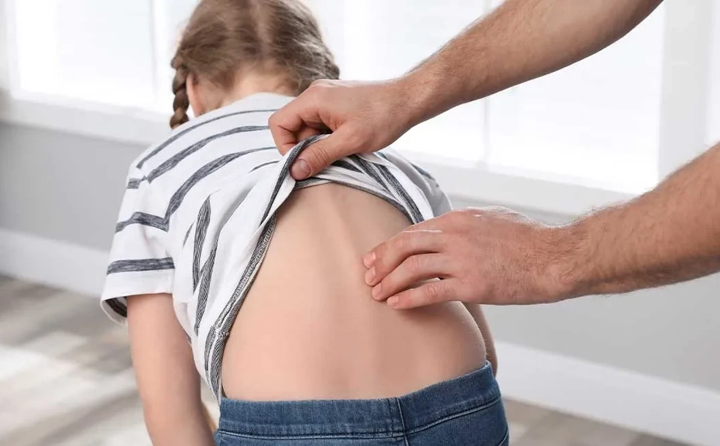 Çocuklarda Skolyoz (Omurga Eğriliği) Tedavi Yöntemleri