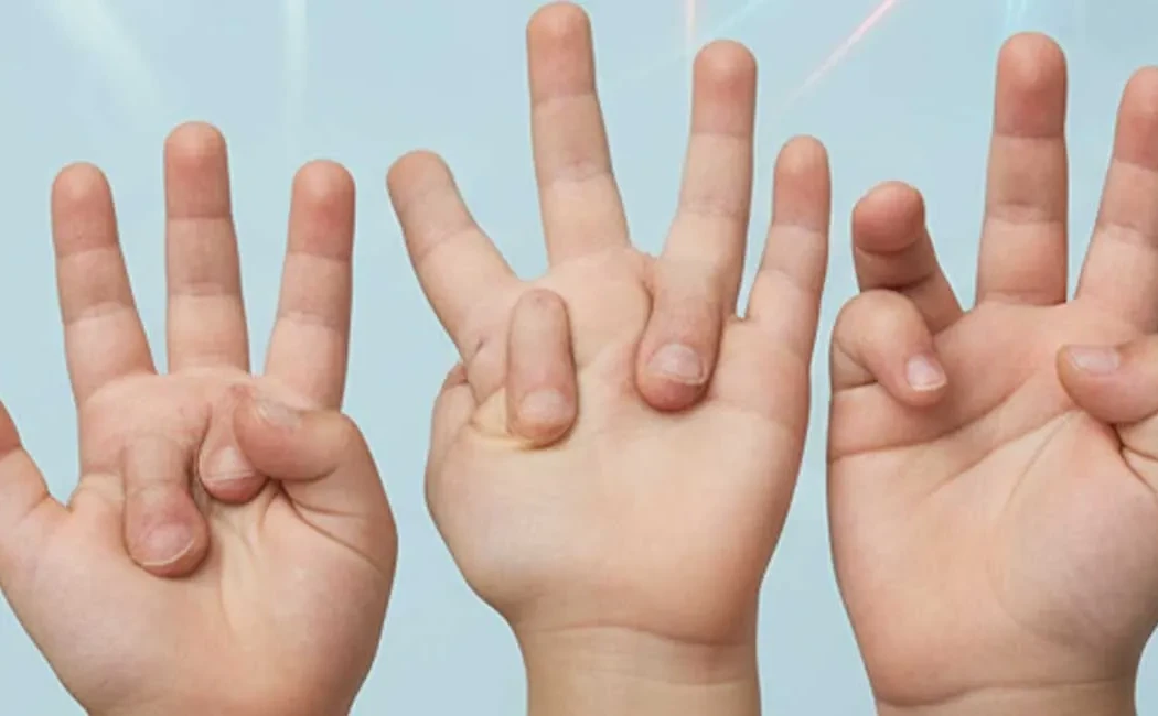 Çocukluk Çağı Ender Deformiteleri: Belirtiler ve Tedaviler