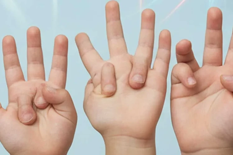 Çocukluk Çağı Ender Deformiteleri: Belirtiler ve Tedaviler