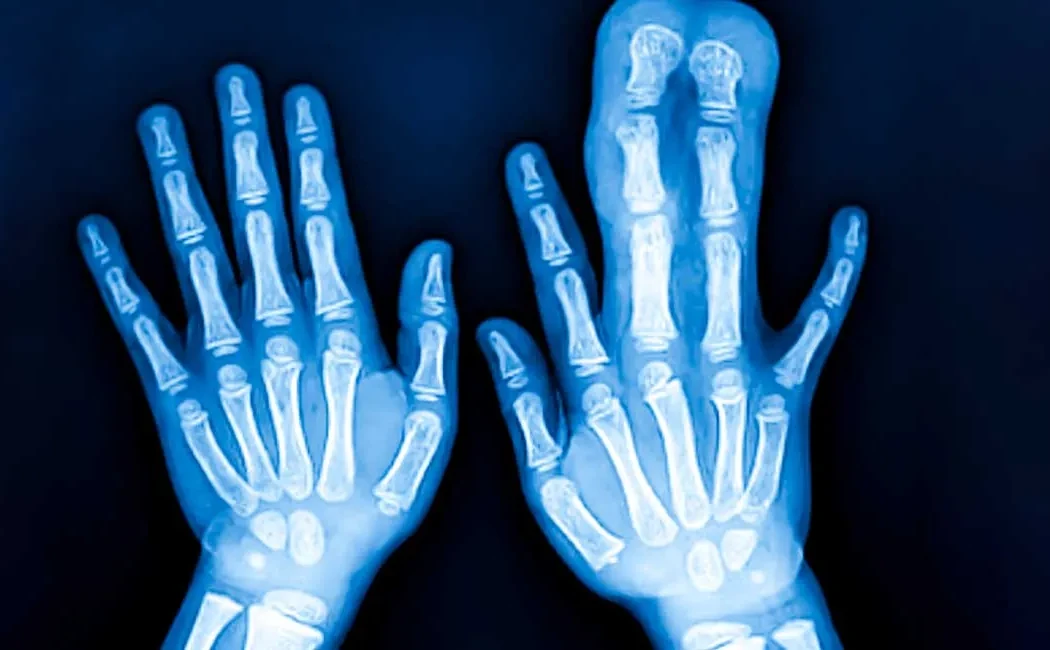 Deformite Cerrahisinde Hangi Yaşlarda Başarı Daha Yüksek?