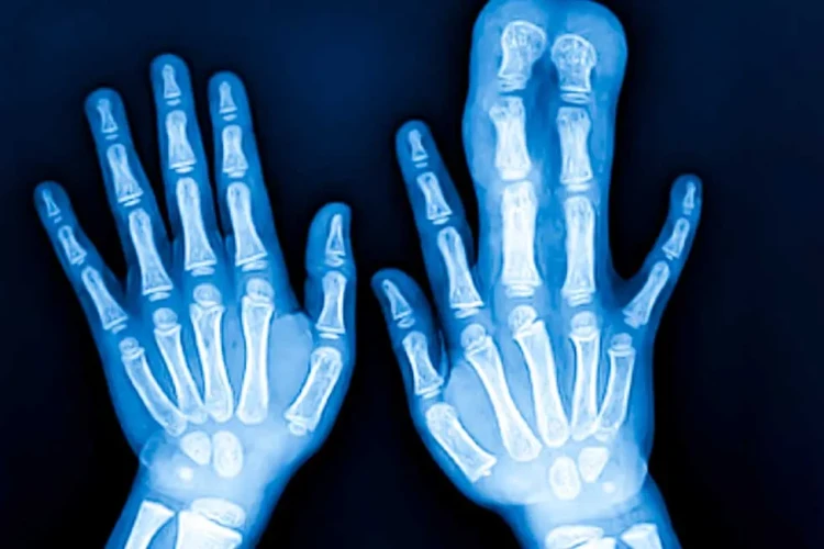 Deformite Cerrahisinde Hangi Yaşlarda Başarı Daha Yüksek?