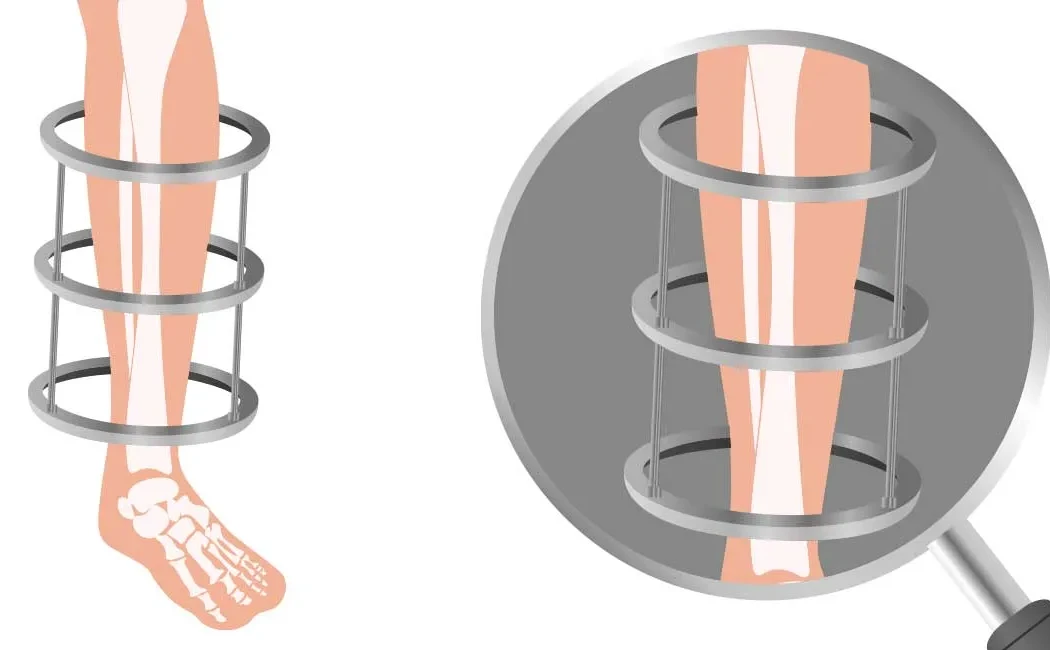 Deformite Cerrahisinde İlizarov ile Düzeltme Başarı Oranları