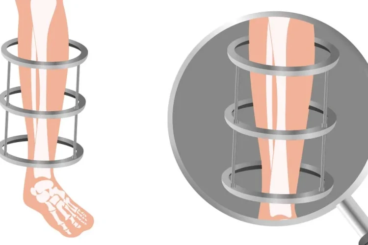 Deformite Cerrahisinde İlizarov ile Düzeltme Başarı Oranları