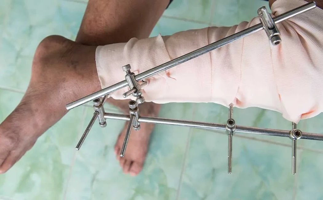 Ekstremite Uzatma Cerrahisi: Yöntemler ve Karşılaştırmalar