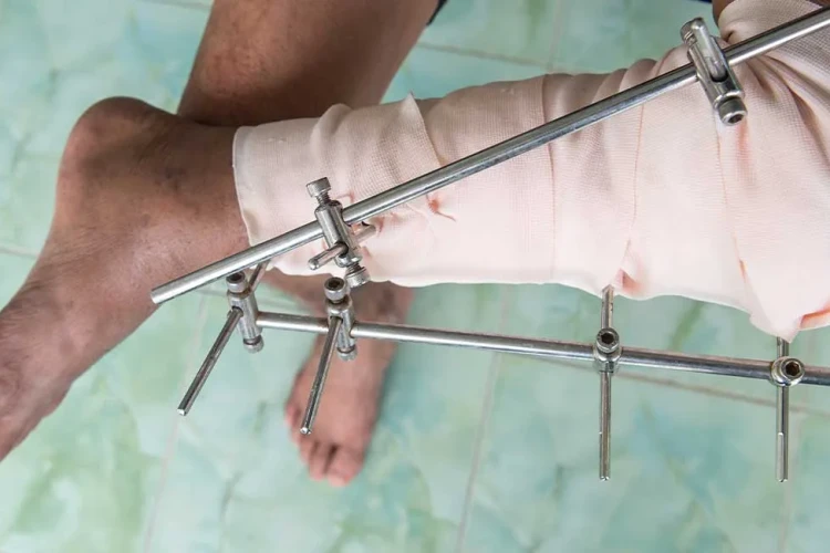 Ekstremite Uzatma Cerrahisi: Yöntemler ve Karşılaştırmalar