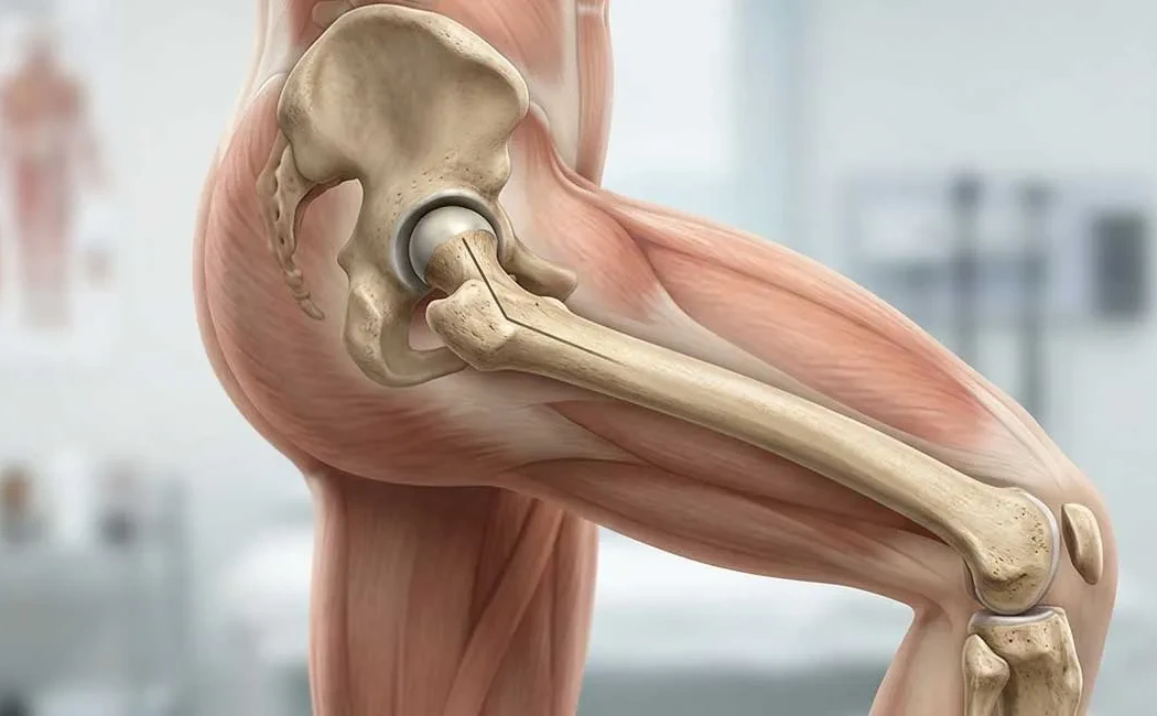 Femoral Anteversiyon Nedir? Tanı ve Cerrahi Tedavi Yöntemleri