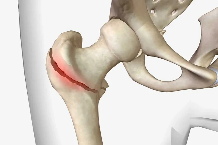 Femur Kırıklarında Kaynamama Sorunu ve Cerrahi Yaklaşımlar