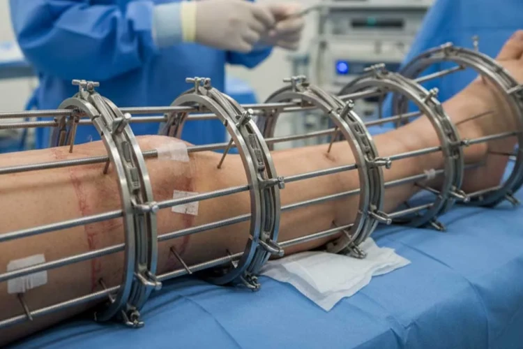 İlizarov Cerrahisi Nedir? Tedaviler, Kullanım Alanları ve Bilmeniz Gerekenler