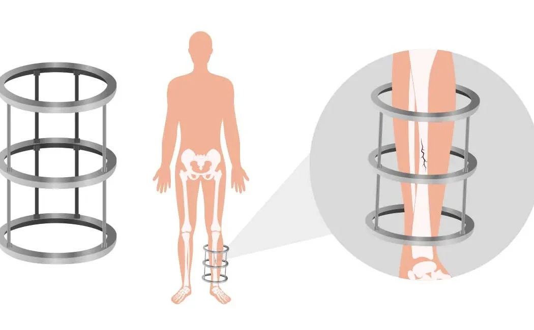 İlizarov Tekniği ile Hangi Deformiteler Düzeltilir?