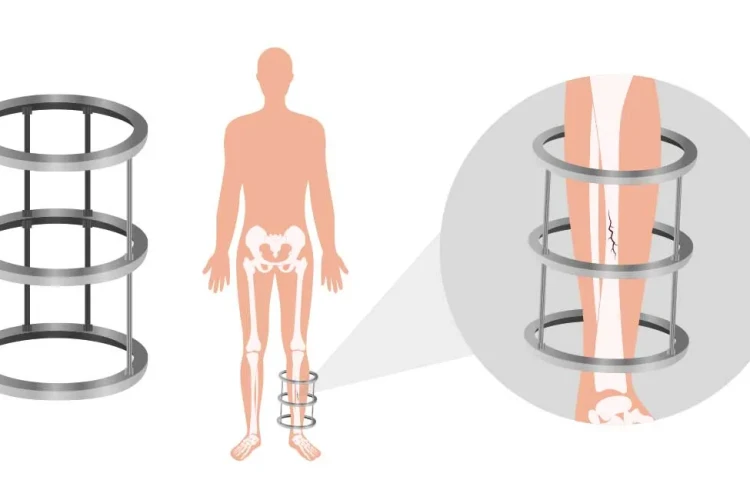 İlizarov Tekniği ile Hangi Deformiteler Düzeltilir?