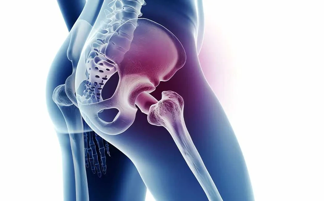 Kalça Ekleminde Artroz: Belirtileri ve Tedavi Yöntemleri