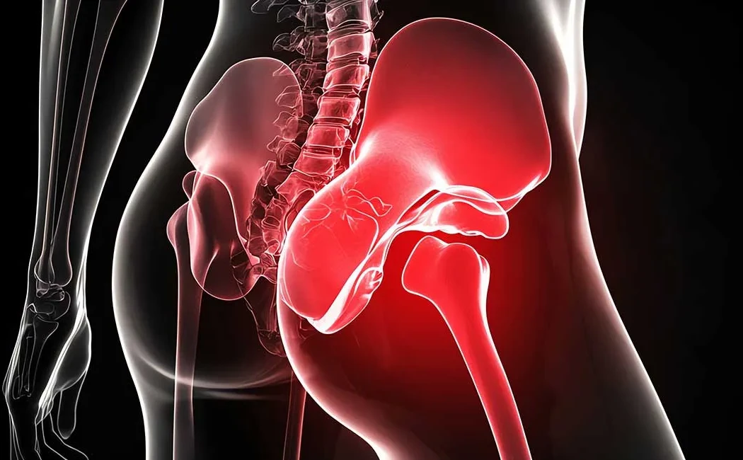 Kalça Kireçlenmesi ve Koksartroz: Protez Cerrahisi Rehberi