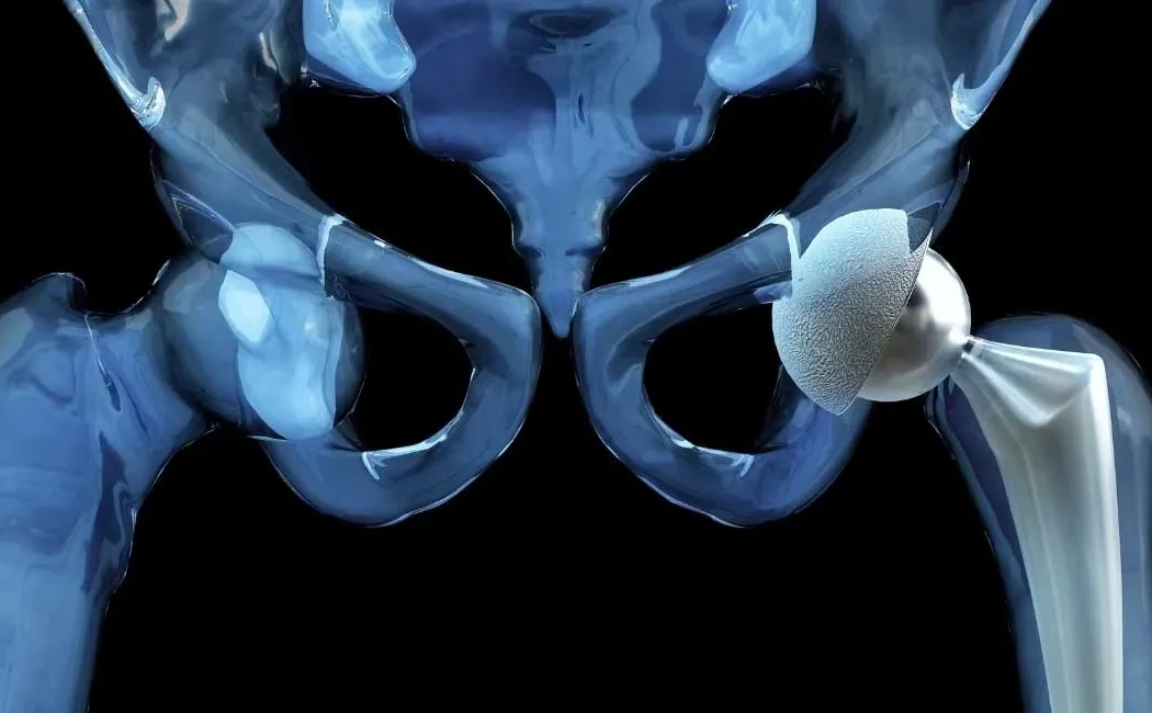 Kalça Protezi Ameliyatı Sonrası Günlük Hayata Dönüş Süresi