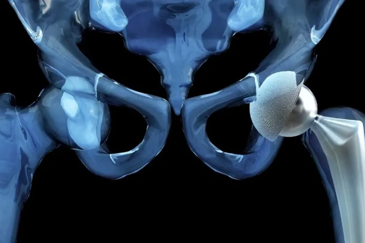 Kalça Protezi Ameliyatı Sonrası Günlük Hayata Dönüş Süresi