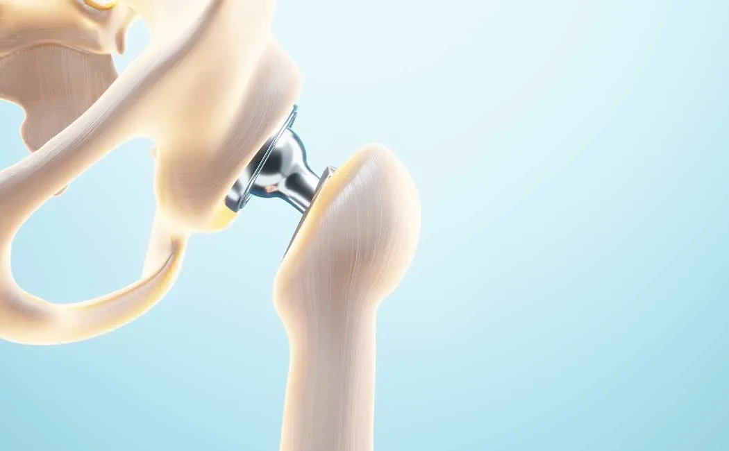 Kalça Protezi Cerrahisi: Modern Yöntemler ve Dayanıklılık