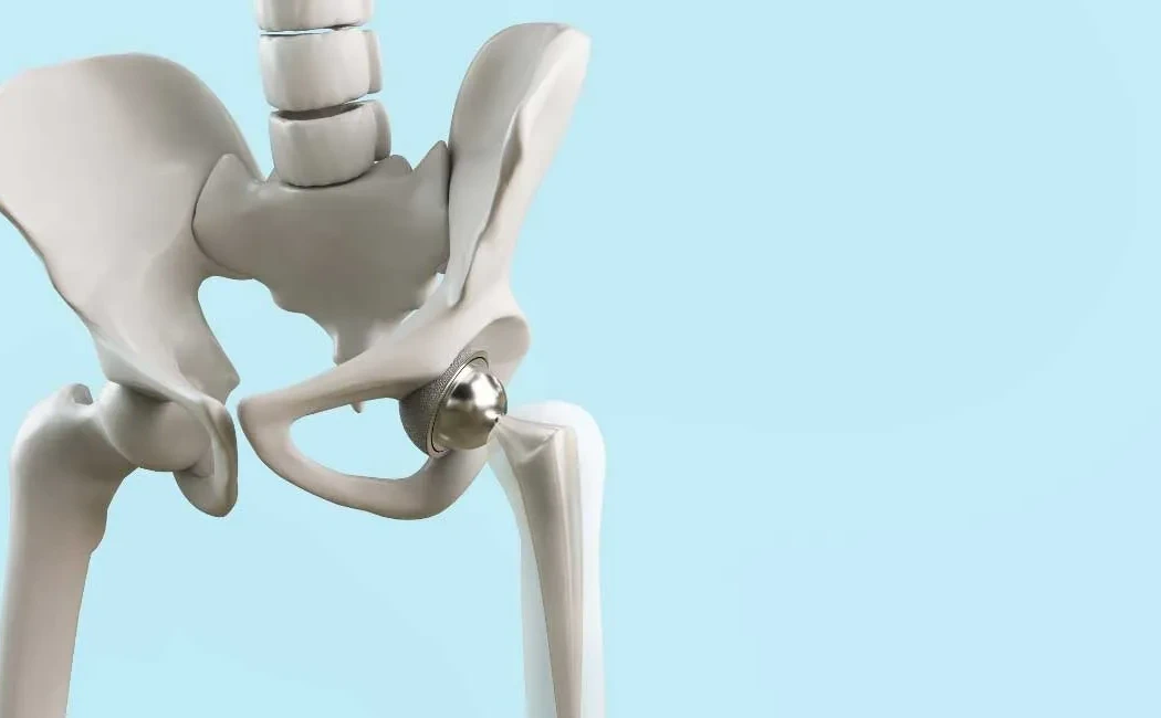 Kalça Protezinde Güncel Yaklaşımlar: Hangi Hastalara Önerilir?