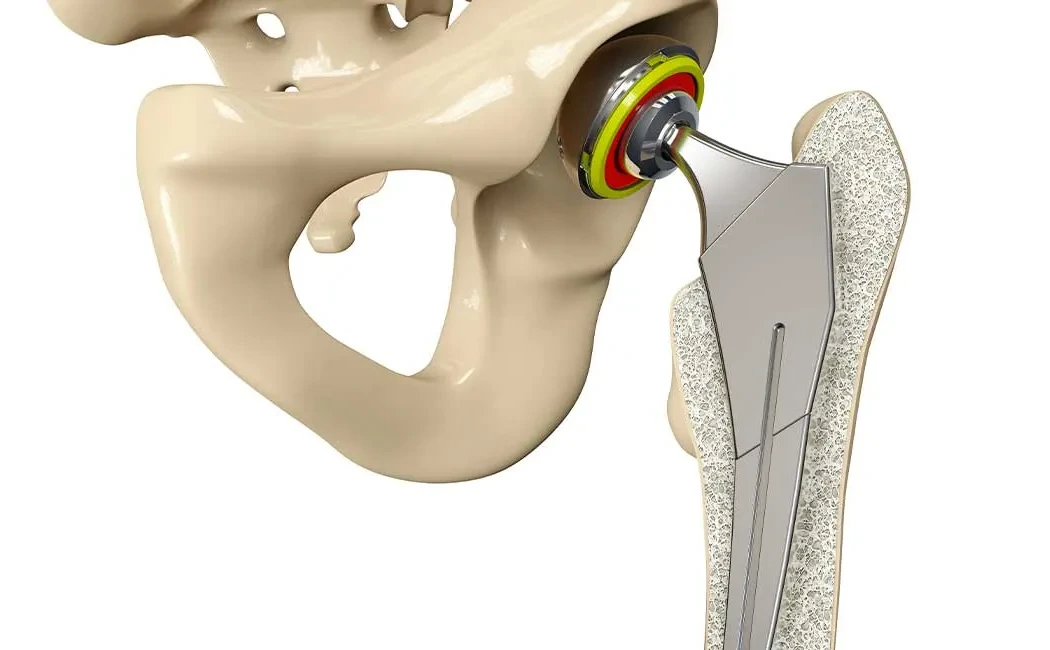 Kalça Protezinde Robotik Cerrahi: Avantajları ve Dezavantajları
