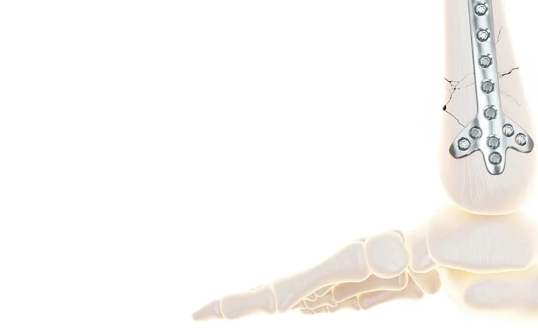 Kaynamama Cerrahisinde Kullanılan Plak ve Çiviler