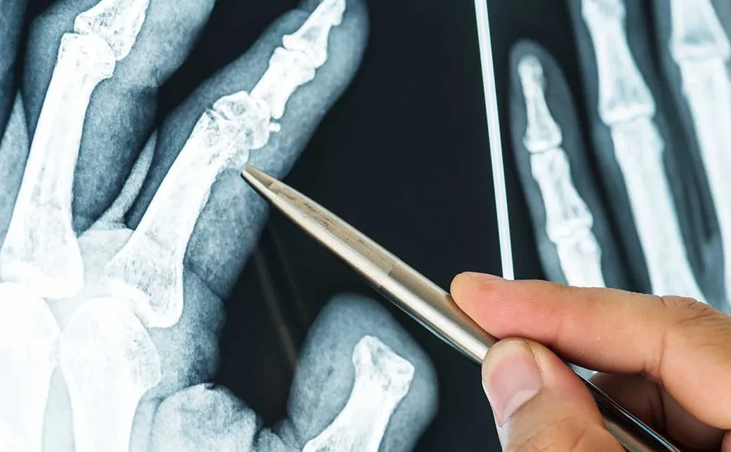 Kaynamayan Kırık (Psödoartroz) Tedavisi: Çözüm Yolları