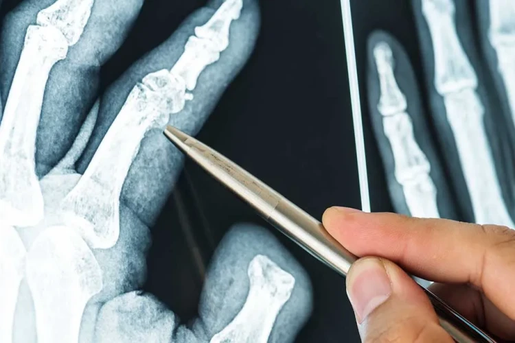 Kaynamayan Kırık (Psödoartroz) Tedavisi: Çözüm Yolları