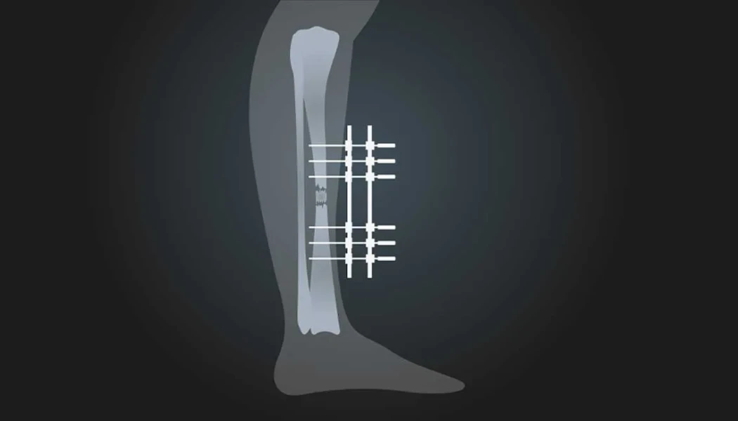 Use of External Fixators in Non-Union Fractures