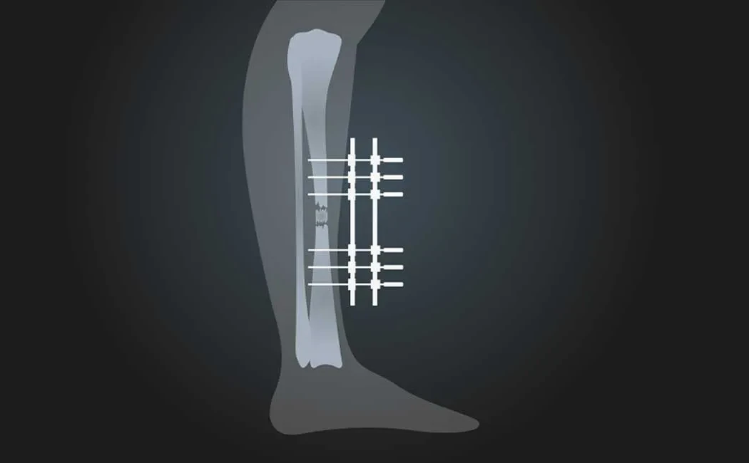 Kaynamayan Kırıklarda Dış Fiksatör Kullanımı