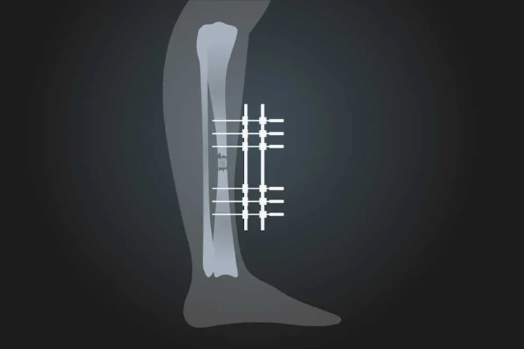 Kaynamayan Kırıklarda Dış Fiksatör Kullanımı