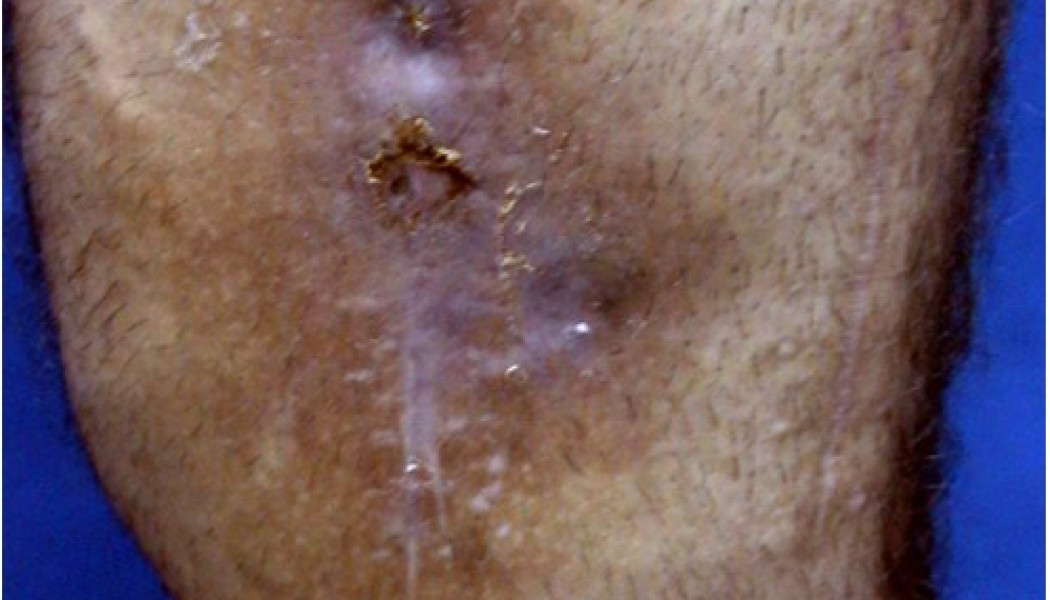Bone Infection Treatment: Osteomyelitis and Soft Tissue Infections