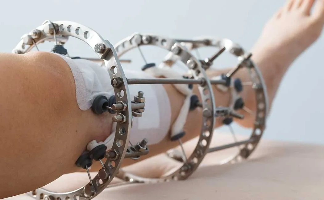 Kemik Deformitelerinde İlizarov Tekniğinin Rolü