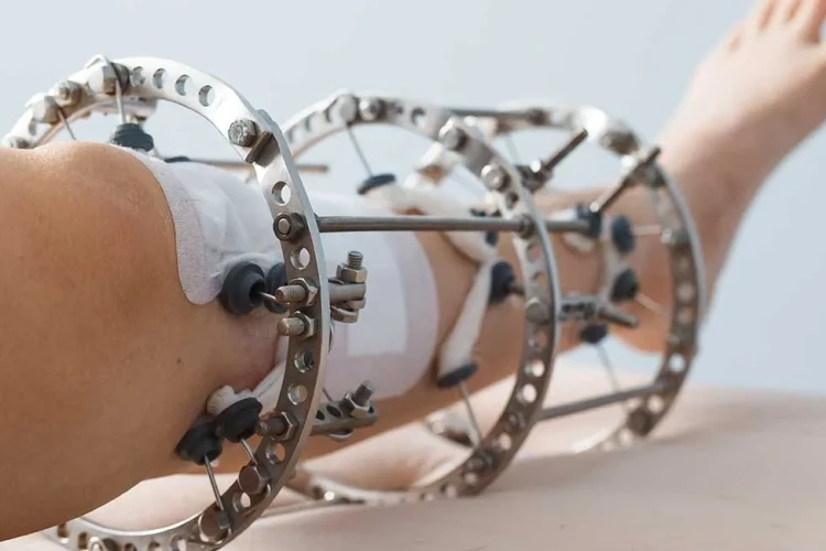 Kemik Deformitelerinde İlizarov Tekniğinin Rolü