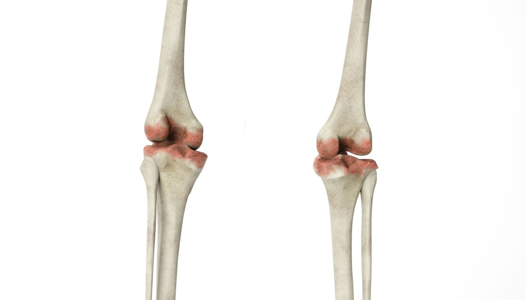 Bone Tumours: Benign and Malignant Types, Diagnosis and Treatment