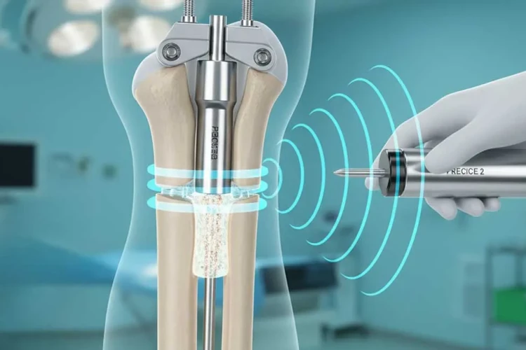 Precice 2 Çivi Yöntemi: Manyetik Boy Uzatma Cerrahisi ve Avantajları