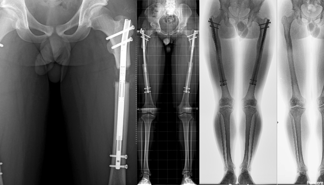 Leg Length Discrepancy and Medical Limb Lengthening