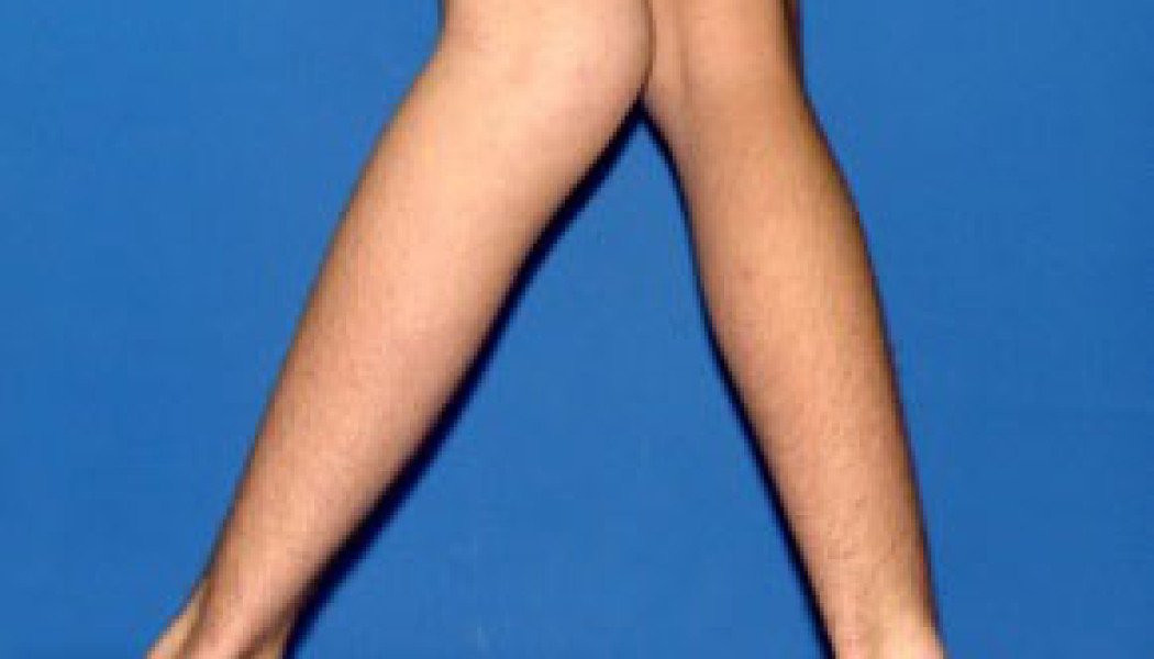 Paediatric Orthopaedics: Common Bone and Joint Problems in Children