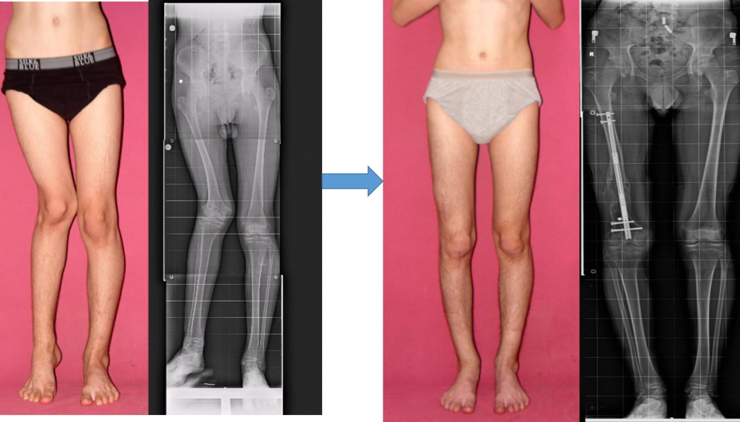 Adult Leg Deformity Correction: Bow Legs and Knock Knees