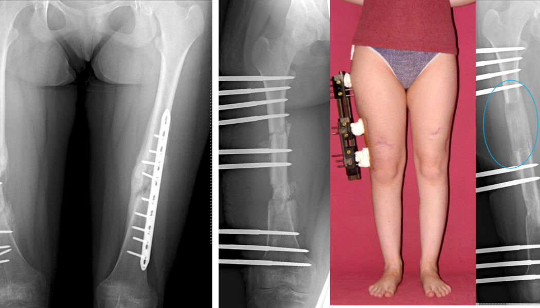 Revision Surgery for Complex and Infected Nonunion