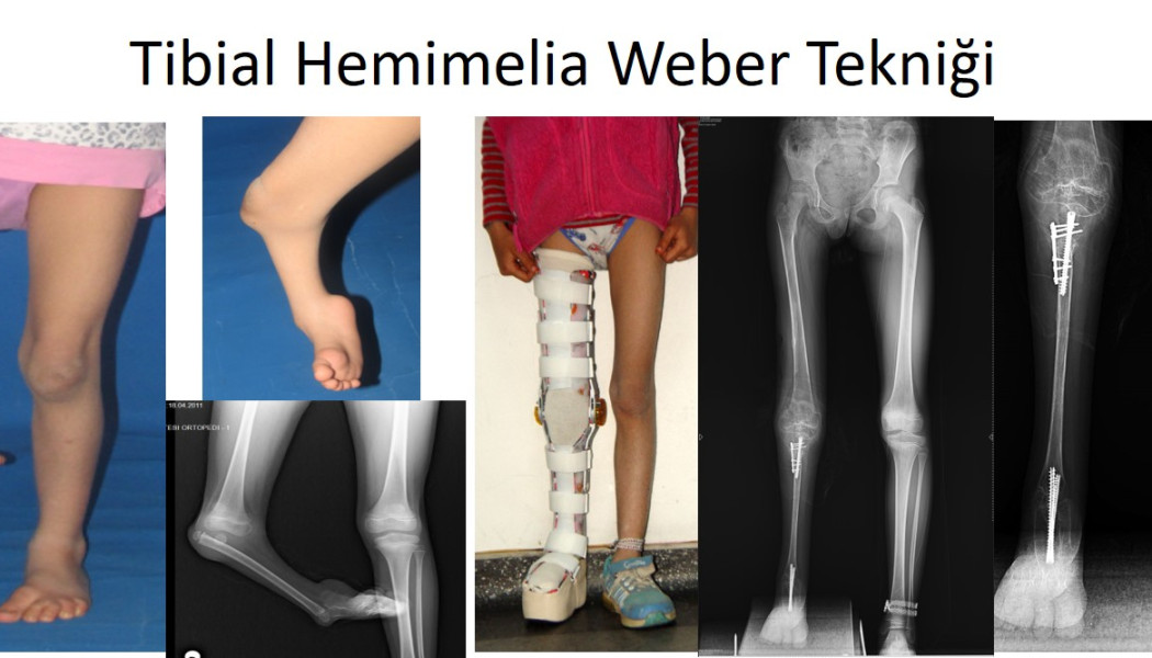 Rare Childhood Limb Deformities: Fibular Hemimelia, Femoral Deficiency