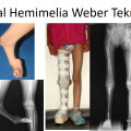 Çocukluk Çağı Ender Görülen Deformiteleri