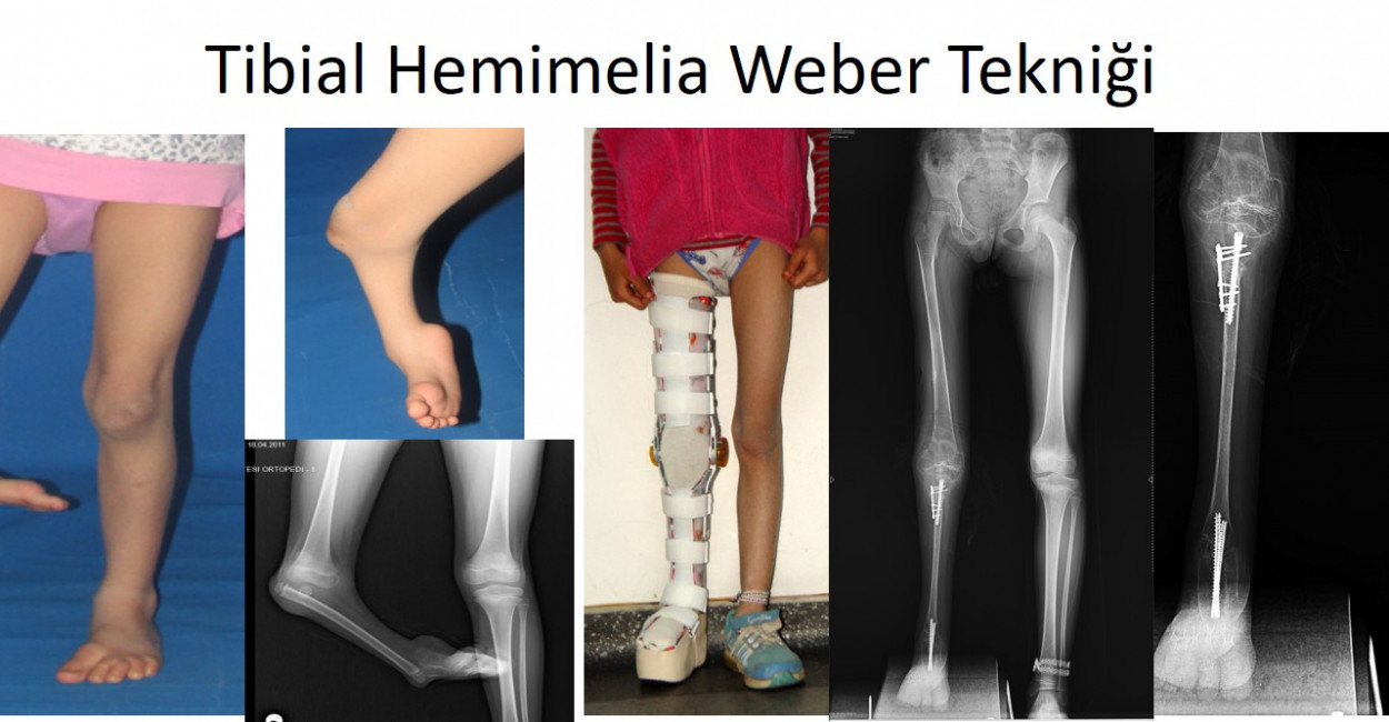Çocukluk Çağı Ender Görülen Deformiteleri