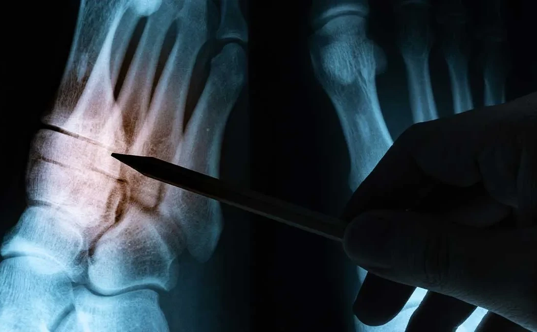 Malunion Surgery: Treating Bone Deformities After Fractures